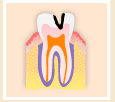虫歯の状態（中度）