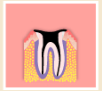 虫歯の状態（最重度）